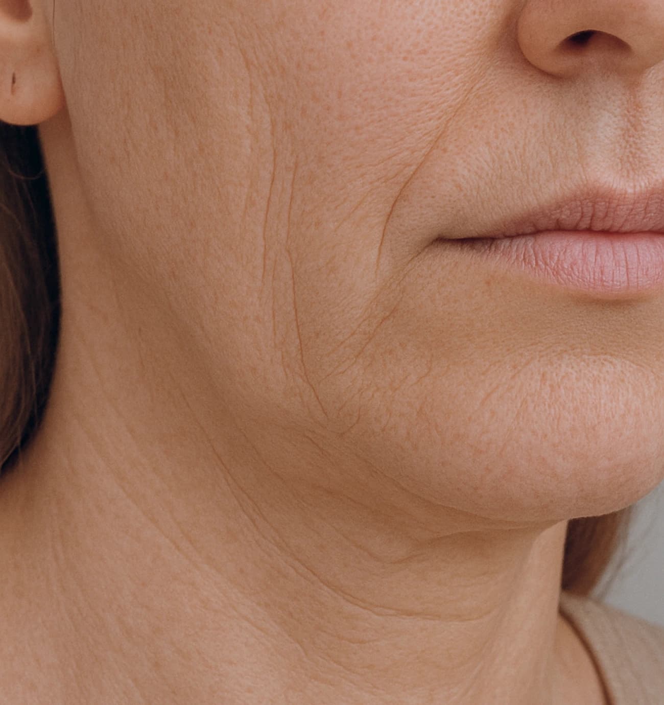 Skin-Laxity-Loose