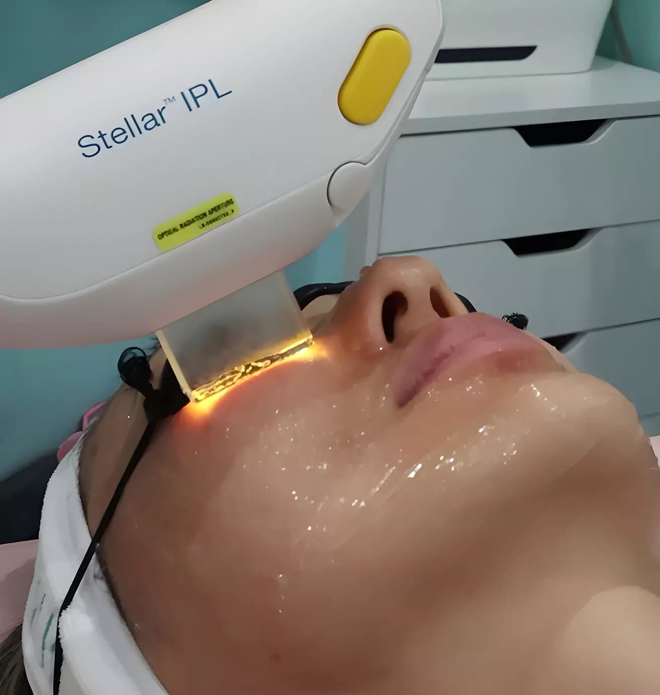 ipl-photofacial