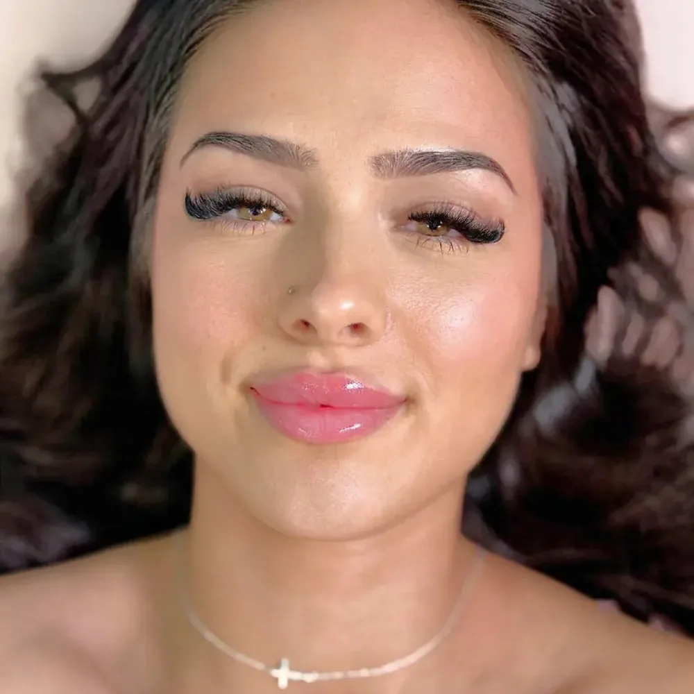 Lip filler result by Botanica Beauty Studio, Bellevue